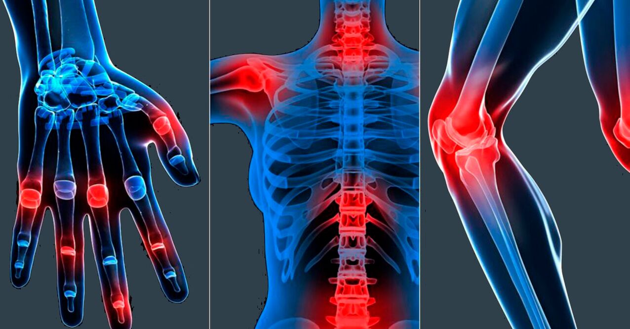 Indikacije za primjenu ekstrakta bosvelije u kapsulama